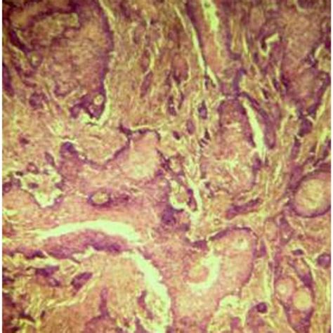 Fine Needle Aspiration Cytology For Diagnosis Of Prepuce Scc