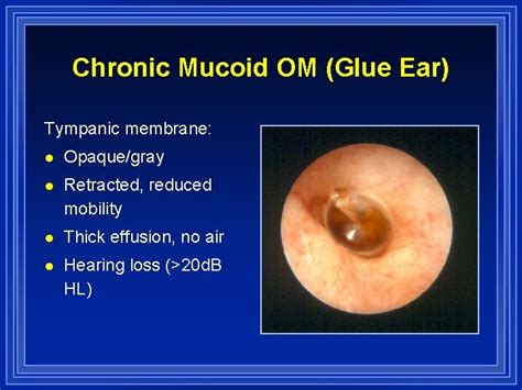 Otitis Media And Eustachian Tube Dysfunction R Kent