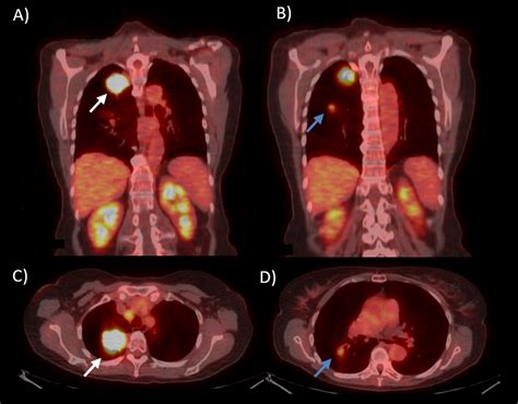 Adenocarcinoma Lung