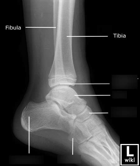 Ankle X Rays Lateral Diagram Quizlet