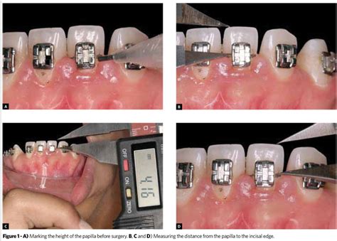 Scielo Brasil Effectiveness Of Co2 Laser In Removal Of Papillary Gingival Hyperplasia