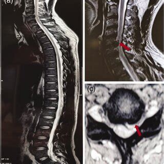 Preoperative Imaging Of The Cervical Spine A B C Magnetic