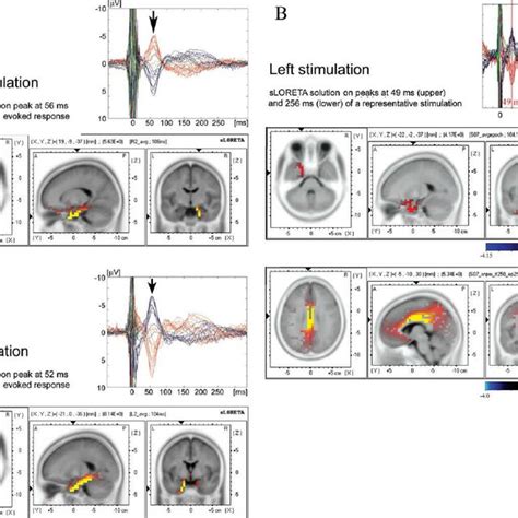 A Location Of Deep Brain Stimulation Dbs Electrode In A Sagittal Download Scientific