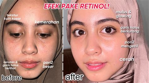 4 Cara Memakai Retinol Yang Benar Supaya Wajah Cepat Glowing Radar