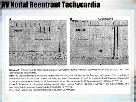 PPT Hemodynamic Monitoring In The CCU PowerPoint Presentation Free