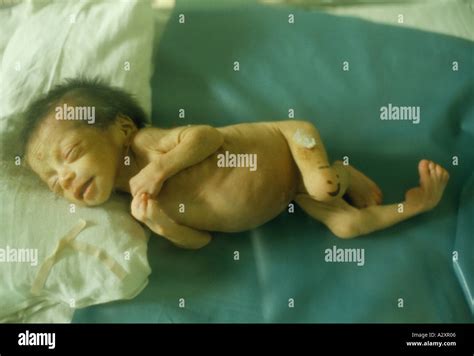 Deformed Baby High Resolution Stock Photography and Images - Alamy