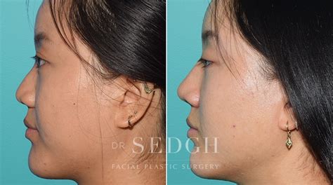 Asian Rhinoplasty Before And After Photos Dr Sedgh