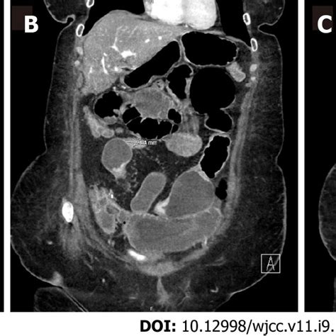 Computed Tomography Enterography Demonstrating Multifocal Stricturing