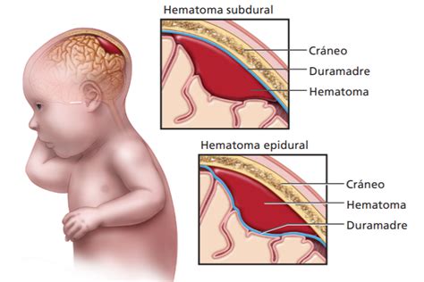 Traumatismo Obst Tricos Cefalohematoma Dr Jos Mar A Mu Oz Conde