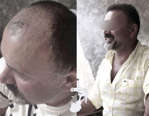 Fue Hair Transplant Before And After Photos Fue Hair Transplant