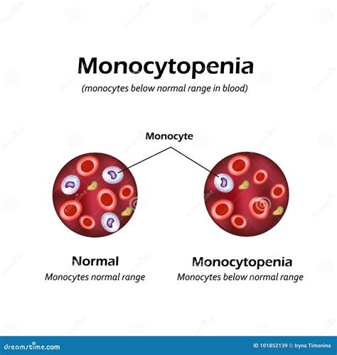 Monocytes Below The Normal Range In The Blood. Monocytopenia. Vector Illustration ...