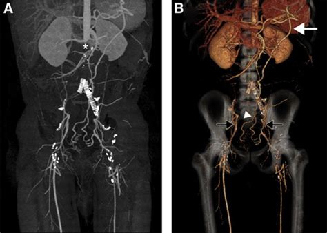 Multimodality Imaging Of Lower Extremity Peripheral Arterial Disease