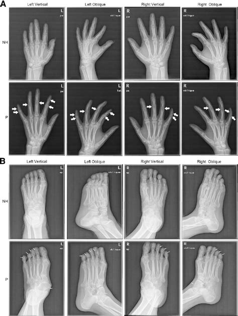 Radiographs Of Hands And Feet Of The Proband And Her Normal Mother A