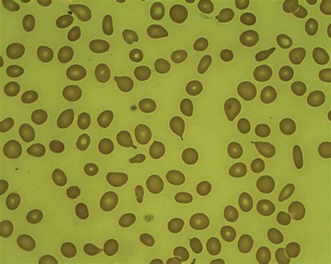 Myelofibrosis Teardrop Cells