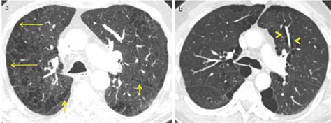 Imaging Of Emphysema A Comprehensive Review Intechopen