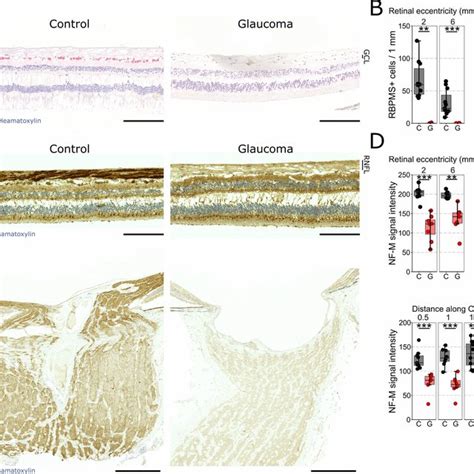 Significant Retinal Ganglion Cell Loss Has Occurred In Late Stage