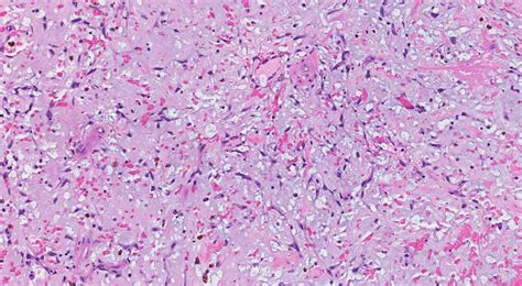 Cardiac Myxoma Atlas Of Pathology