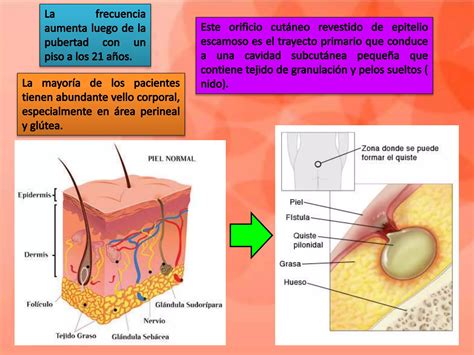 Abscesos Fistulas Anorectales Enfermedad Pilonidal Ppt