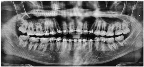 External Resorption Of Tooth