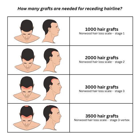 Hair Transplant For Receding Hairline Norwood Scale 2024 Costs