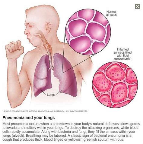 What Do You Know About Pneumonia Pneumonia Symptoms Pneumonia Remedies Pneumonia