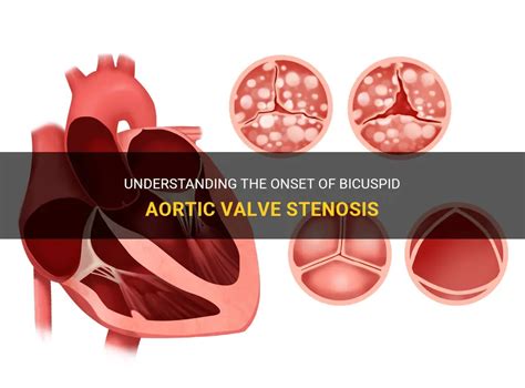 Understanding The Onset Of Bicuspid Aortic Valve Stenosis | MedShun