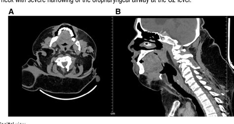 Figure 2 from A case of Madelung's disease presenting with obstructive sleep apnea. | Semantic ...