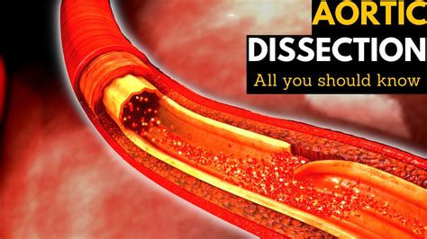 Aortic Dissection Causes Signs And Symptoms Diagnosis And Treatment