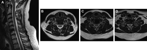 Postoperative Mri Visualization Of The Cervical Spine Following