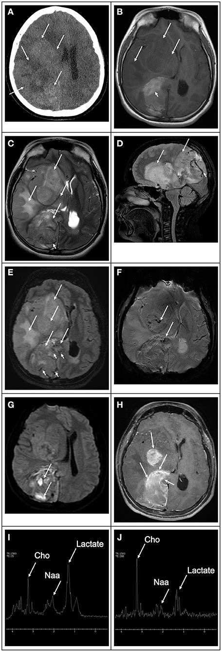 Frontiers Advanced Magnetic Resonance Imaging In Pediatric Glioblastomas