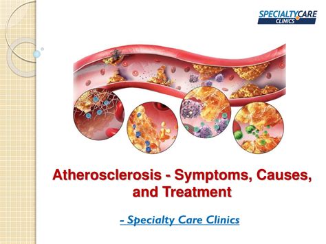 Ppt Atherosclerosis Symptoms Causes And Treatment Powerpoint