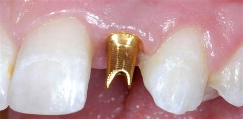 Platinum Gold Teeth