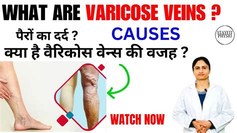 Varicose Veins Causes Leg Pain Blue Veins In Legs Spider Veins पैरों की वेरिकोज़ नस