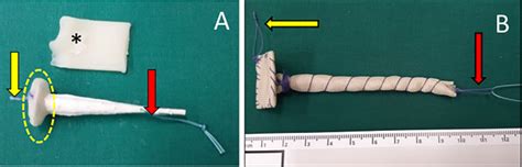 Combined Endoscopic Percutaneous Treatment Of Upper Gastrointestinal