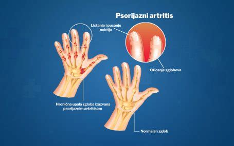 Biološki lekovi značajan napredak u tretmanu psorijaznog artritisa