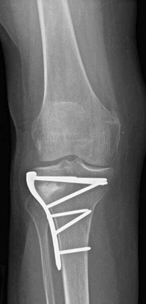 HIGH TIBIAL OSTEOTOMY – Di Nallo Orthopaedics