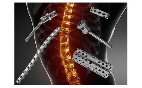 The Spinal Implants And Surgical Devices Market Size To Grow At A CAGR