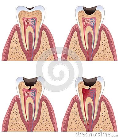 Caries Stages Stock Image - Image: 19737411