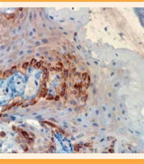 Inmunohistoquímica positiva para tinción de P16 que orienta hacia una