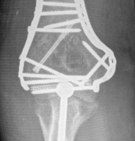 Elbow Fracture Fixation | Michael Boin, MD