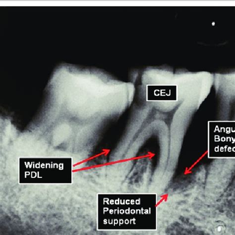 Proximal Digital Radiographic Alveolar Bone Loss Drabl Was Defined As