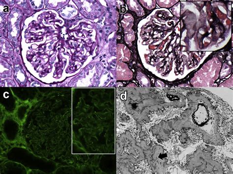 By Light Microscopy The Glomeruli Show Mild Mesangial Matrix Expansion