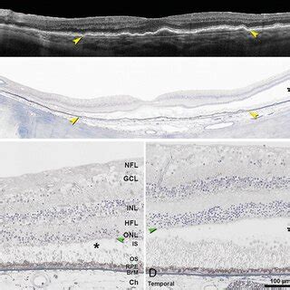 Bacillary Layer Detachment Associated With Acute Idiopathic Maculopathy