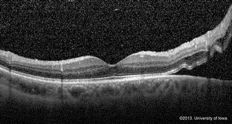 Retinal Detachment From One Medical Student To Another