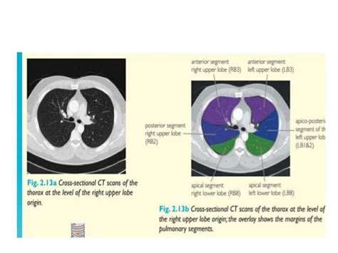 BRONCHOPULMONARY SEGMENTS OF THE LUNG