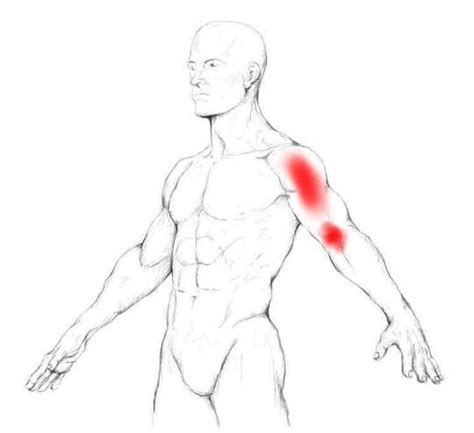 Biceps tendonitis cause and treatment with 3 exercises