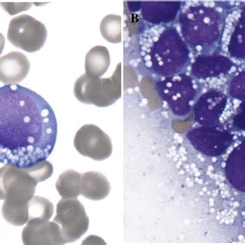 Bone Marrow Biopsy The Blasts Are Variably Positive For Cd A And