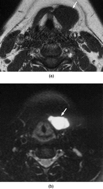 Imaging For Thyroglossal Duct Cyst The Bare Essentials Clinical