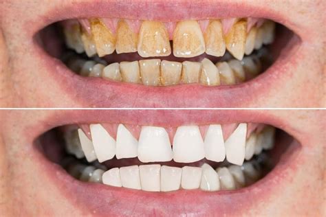 Before And After Dental Images Browse 3 073 Stock 50 OFF