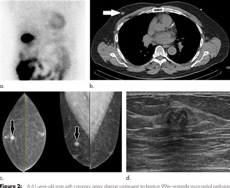 Figure From Management Of Incidental Breast Lesions Detected At